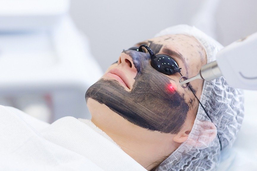 Laser Carbon Peel